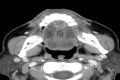 Can a PET scan detect squamous cell carcinoma?