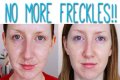 Can you remove freckles?