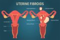 Does subserosal fibroid cause infertility?