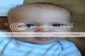 What does it mean when a baby has a protruding forehead?