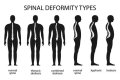 What is the icd 10 code for kyphoscoliosis?